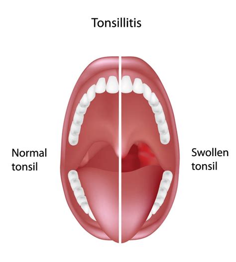 The Role of Stress and Anxiety in Experiencing Dreams of Expectorating Tonsil Calculi