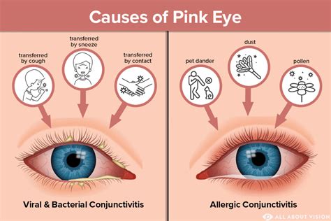 The Root Causes of Conjunctivitis: Understanding the Origins