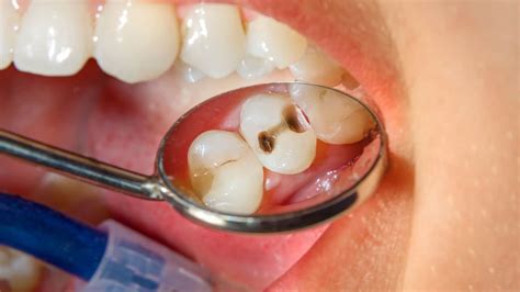 The Science Behind Dental Cavities