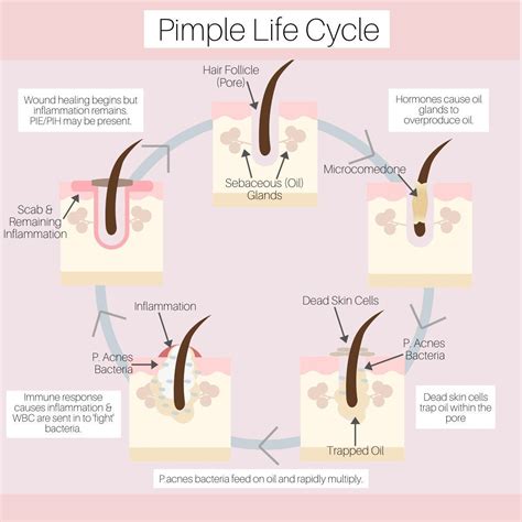 The Science Behind Pimple Formation and Growth