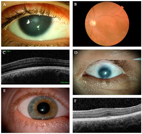 The Science Behind Silver Eyes: Genetic Mutations and Pigmentation