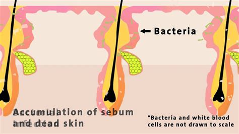 The Science Behind the Formation of Acne