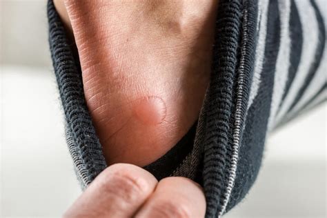 The Science behind Skin Blisters and their Underlying Factors