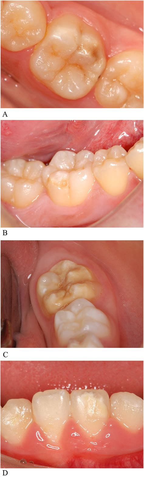 The Scientific Explanation for Discolored Tooth Enamel in Dreams