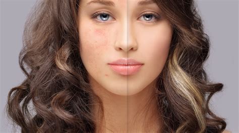 The Scientific Understanding of Acne Scar Formation: Unraveling the Underlying Causes