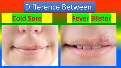 The Significance of Accurate Diagnosis: Distinguishing Between Fever Blisters and Cold Sores