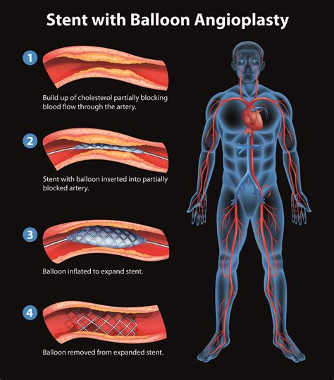 The Significance of Cardiac Intervention in Preserving Lives