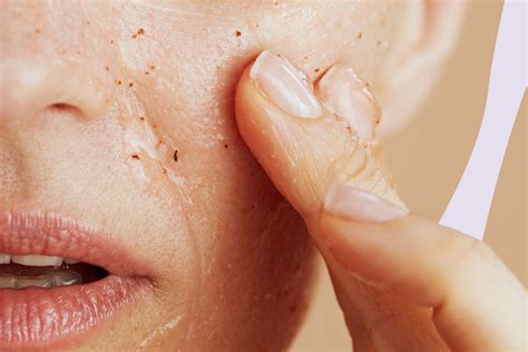 The Significance of Diet and Lifestyle in Tackling Blackheads