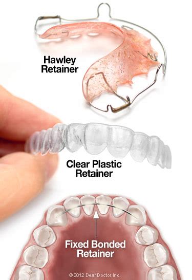 The Significance of Retainers in Orthodontic Treatment