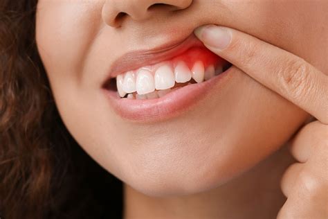 The Sticky Situation: Understanding the Gum Getting Trapped in Your Oral Cavity