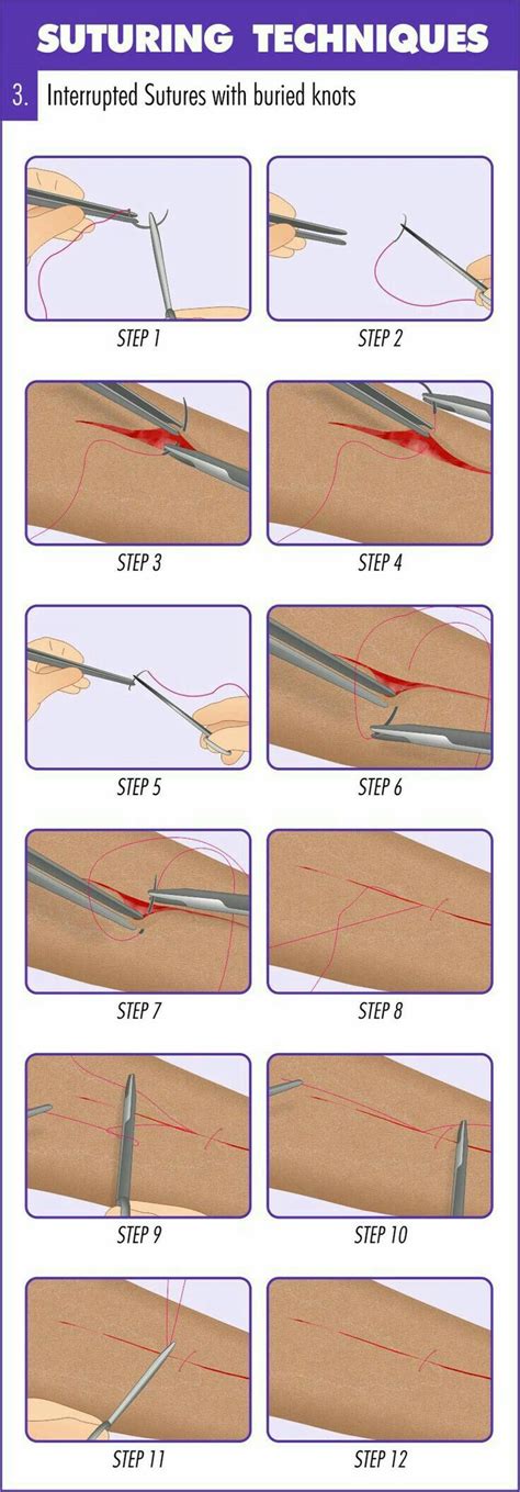 The Surgical Procedure: A Step-by-Step Guide to Limb Transplantation