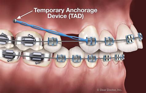 The Symbolic Significance of Dreams Depicting the Removal of Orthodontic Devices