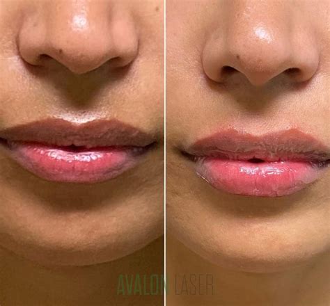 The Temporary Solution: Exploring the Duration of Lip Enhancements