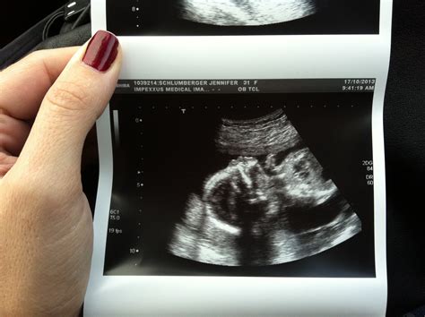 The Thrill and Debate Surrounding Gender Reveal Sonograms