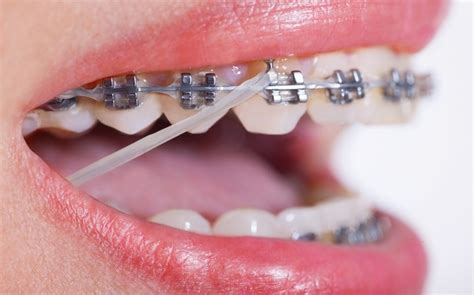 The Transformation of Your Dental Beauty: The Role of Orthodontics