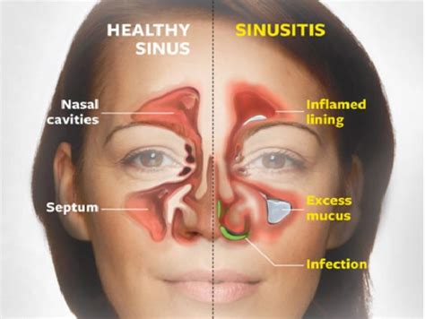 The Unexpected Link Between Nasal Secretions and the Immune System