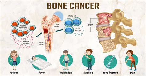 The Uniqueness of Living with Bone Cancer