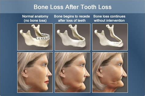 Tips for Analyzing and Decoding Dreams Portraying the Loss of Dentures