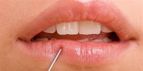 Tips for Preventing and Managing Numb Lips