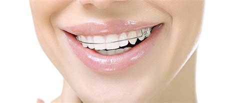 Tips to Maintain Your Retainer and Prevent Damage