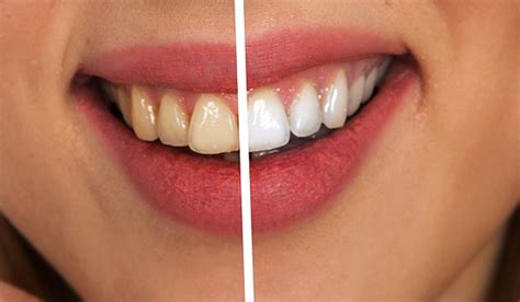 Transforming From Stained to Dazzling: Effective Solutions for Teeth Discoloration