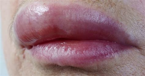 Trauma and Swollen Lips: Understanding the Impact