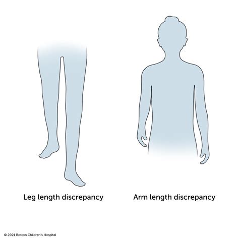 Traumatic Events: The Impact on Disparity in Leg Length