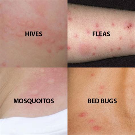 Treating Bedbug Bites and Rashes: