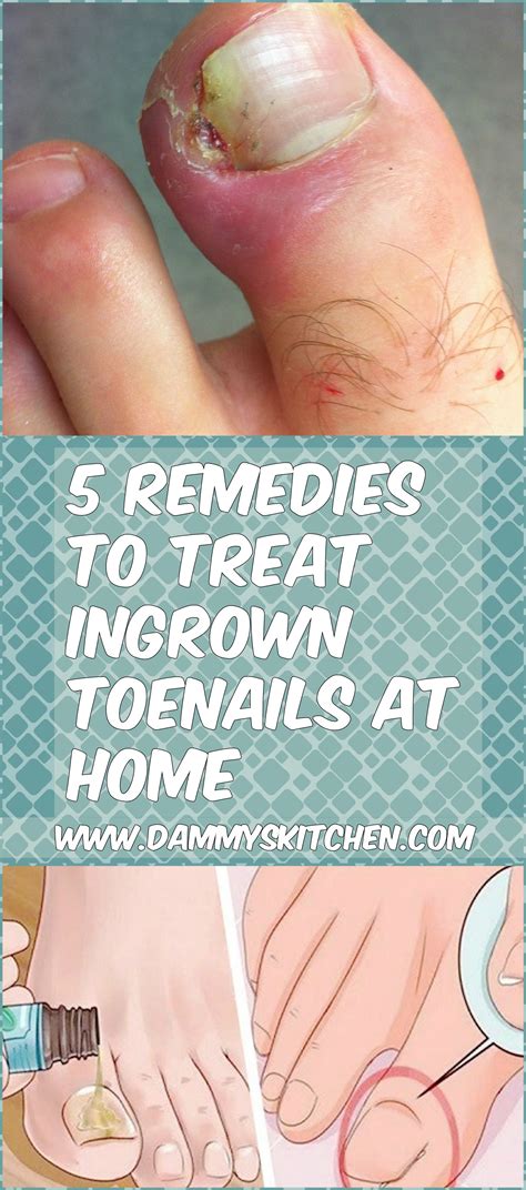 Treating Ingrown Toenails: Medical and Home Remedies