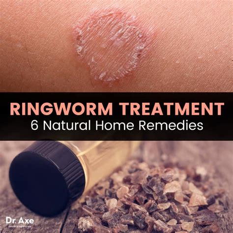 Treating Ring Worm Infections: Effective Remedies and Medications