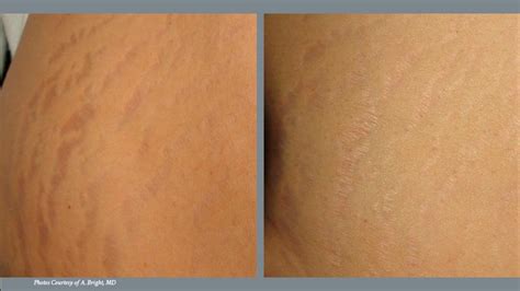 Treating Stretch Marks: Effective and Ineffective Approaches