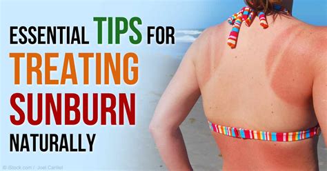 Treating Sunburn: Remedies and Tips for Speedy Recovery