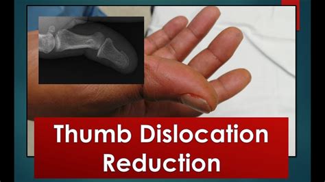 Treatment Approaches for Thumb Dislocation