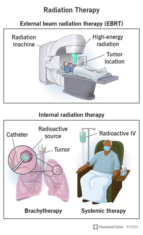 Treatment Options: Surgery, Chemotherapy, and Radiation