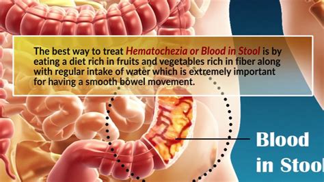 Treatment Options for Blood in Stools: How to Stop the Bleeding