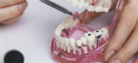 Treatment Options for Dental Cavities