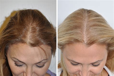 Treatment Options for Female Hair Loss: Exploring Therapies and Transplants