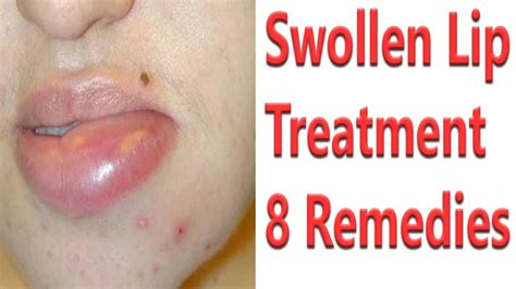 Treatment Options for an Inflamed Lower Lip