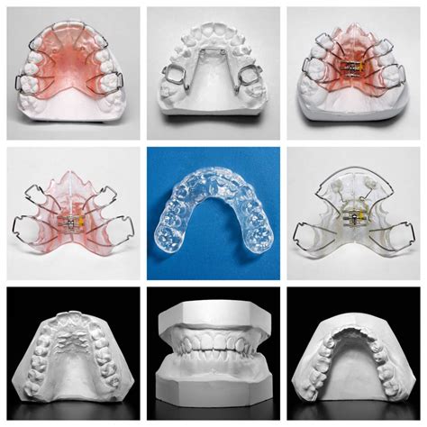 Types of Orthodontic Appliances: Choosing the Best Option for Your Oral Health