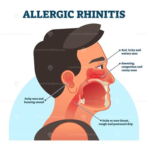 Unconventional Allergens: What Triggers an Itchy Nose in Dreams?