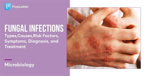 Uncovering the Common Triggers of Fungal Infections