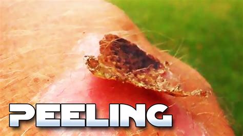 Uncovering the Psychological Significance Behind the Act of Peeling Off Scabs