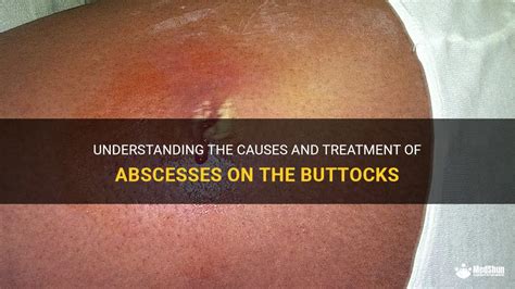 Understanding Abscesses: What You Need to Know