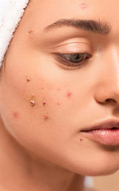 Understanding Acne: Causes and Types