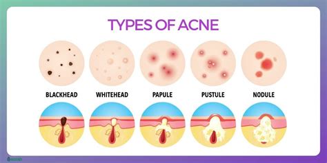 Understanding Acne: Types and Symptoms