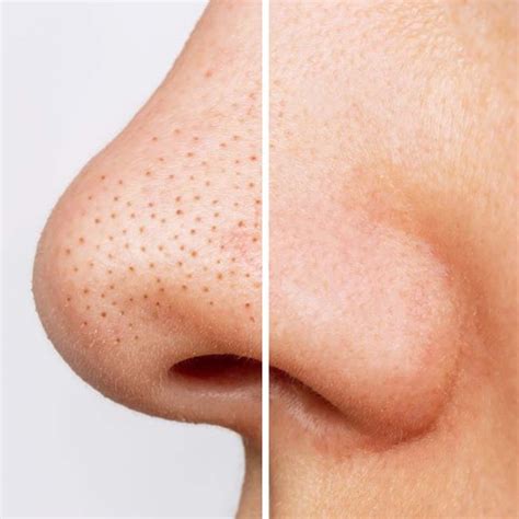 Understanding Blackheads: Causes and Symptoms