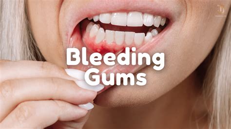 Understanding Bleeding Gums: What Causes It, How to Recognize Symptoms, and Approaches to Treatment