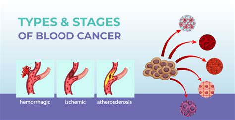 Understanding Blood Cancer: Types and Prevalence