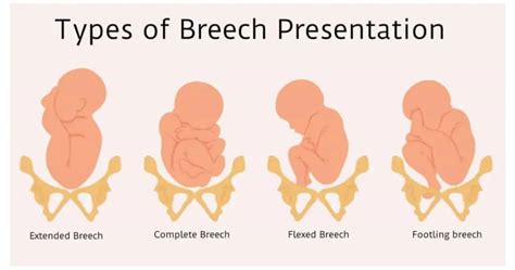 Understanding Breech Birth: Its Significance and Implications