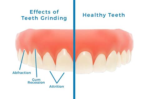 Understanding Bruxism: Exploring the Phenomenon of Clenched Teeth